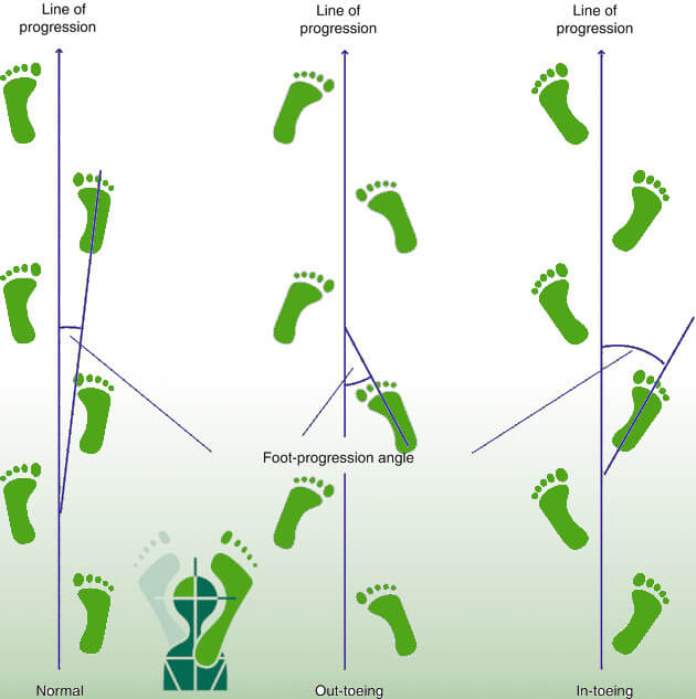 Intoeing of toeing-in - Podocentrum Heerhugowaard